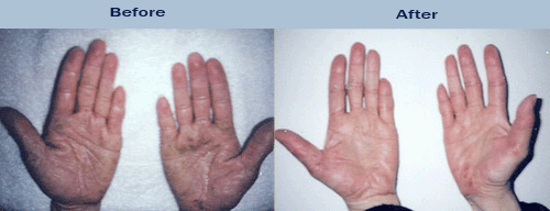 Before and after of patients hands