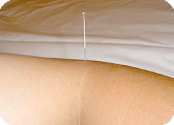 Acupuncture needle inserted into patient's arm